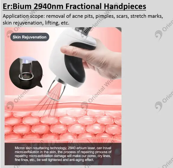न्यू स्किन रिन्यू एक्सपर्ट- 2940 एनएम एर्बियम लेजर