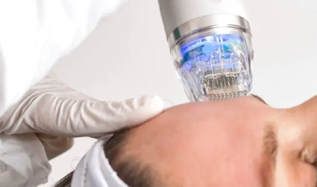 आरएफ माइक्रोनीडलिंग उपचार के क्या लाभ हैं?