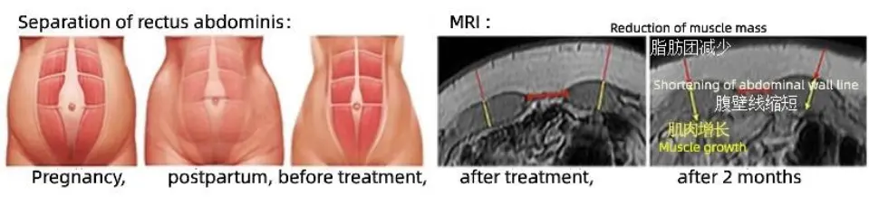 Vertical Rf Ems Body Weight Loss Machine